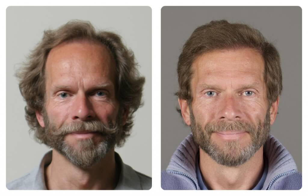 Results of FUE Hair Transplant at My Hair Clinic in Islamabad, Pakistan. Danish famous artist Mikael Melbye