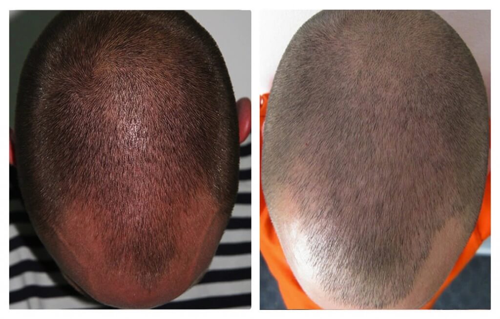 FUE hair transplant at My Hair Clinic in Islamabad. Also clinics in Oslo (Norway) and central London (United Kingdom)