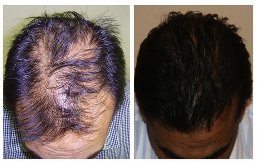 Results after FUE Mega Hair hair transplantation at My Hair Clinic at Islamabad, Pakistan.
