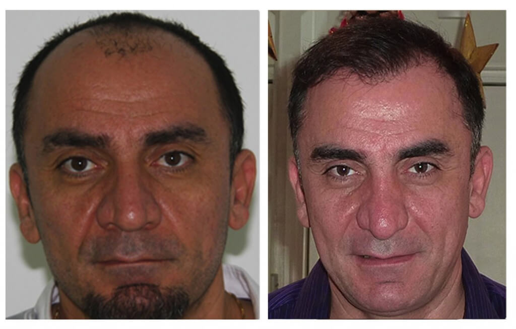 Hair Transplant my hair clinic extra ordinary result 2 in pakistan