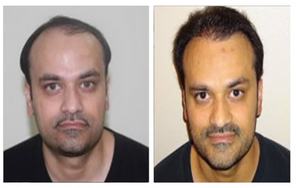 FUE hair replacement at My Hair Clinic in Islamabad, Pakistan. Clinics in Islamabad (Pakistan), London (United Kingdom)