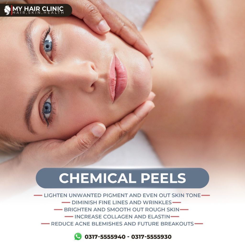 Chemical Peel